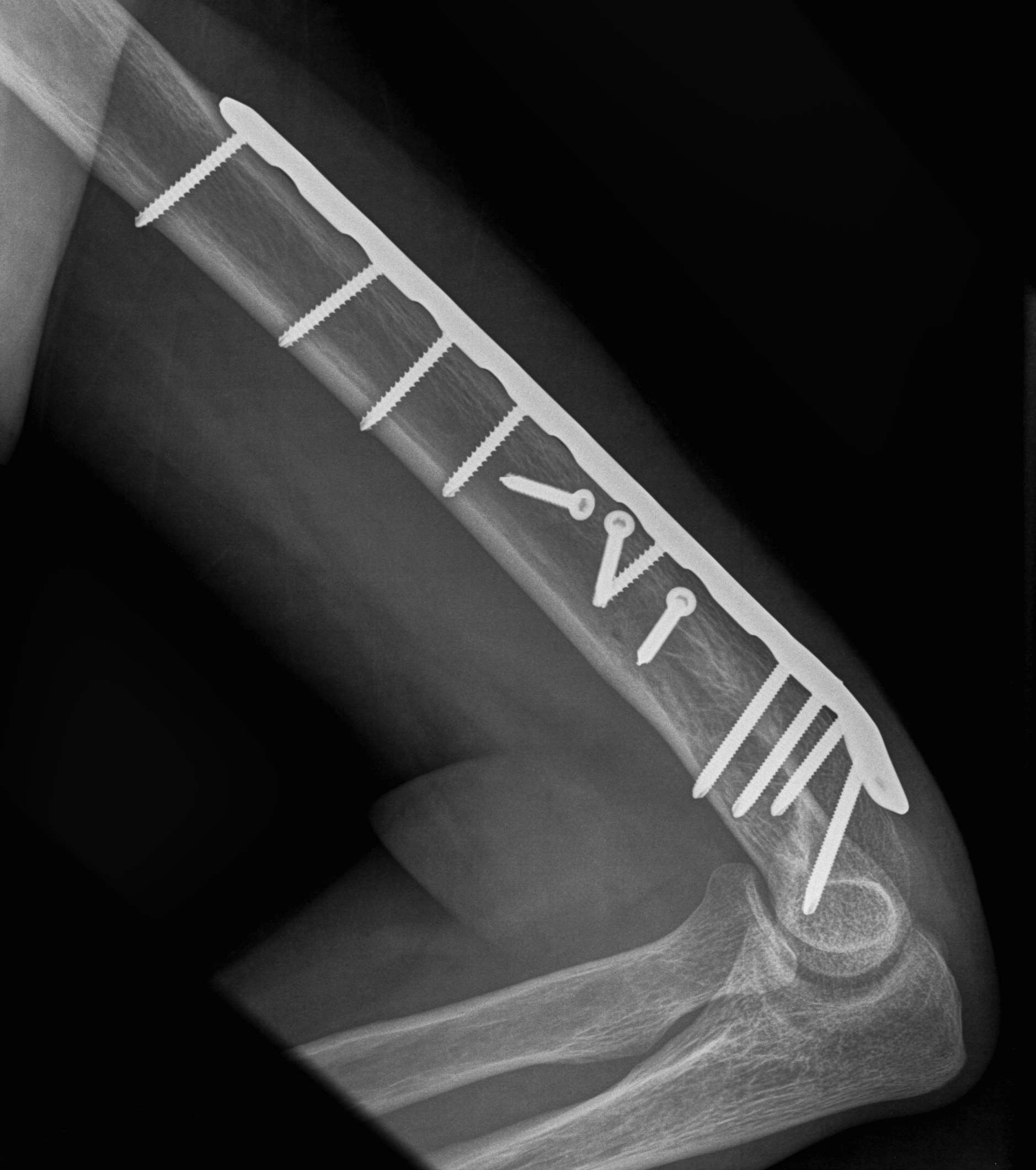 Humerus ORIF Posterior Approach